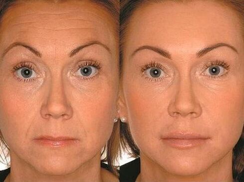 Before and after microcorrent therapy