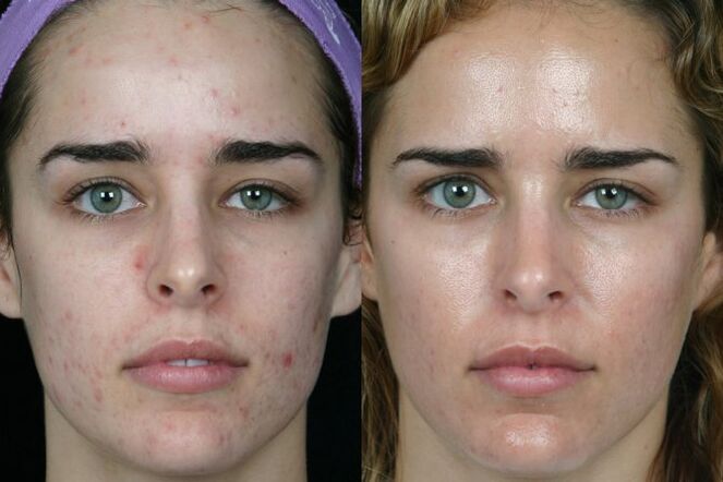 Laser grinding the skin of the face before and after